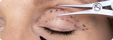 Blefaroplastia Tijuca