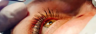 Cirurgia de Catarata Tijuca