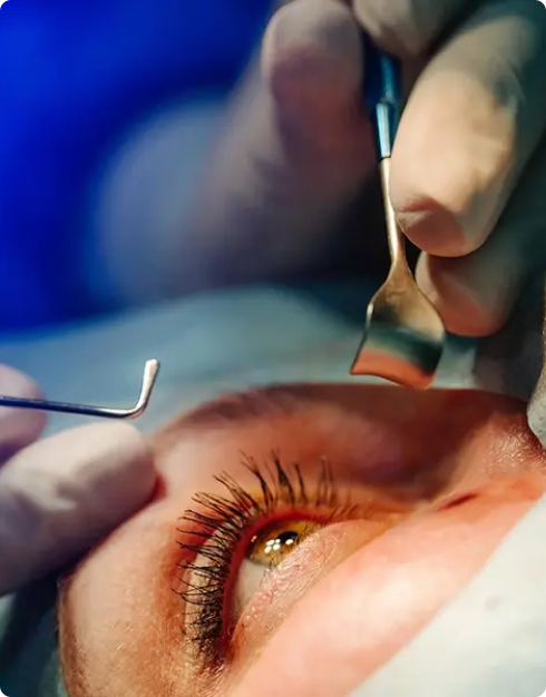 Cirurgia de Catarata