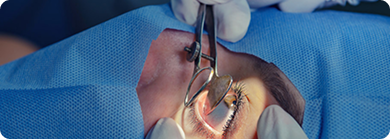 Cirurgia de Catarata Tijuca