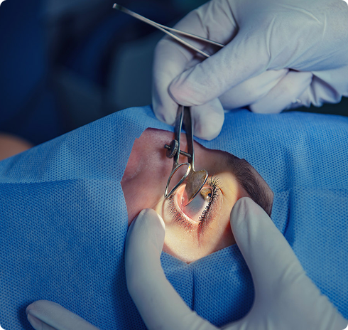 Cirurgia de Glaucoma em tijuca