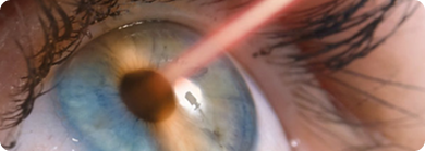 Cirurgia Refrativa Tijuca